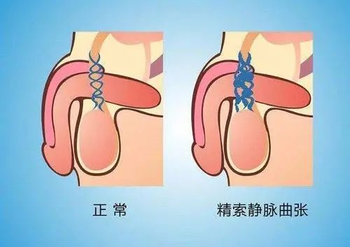 由於它發生在睪丸的精索,所以就叫精索靜脈曲張. 這種疾病到底是什麼?